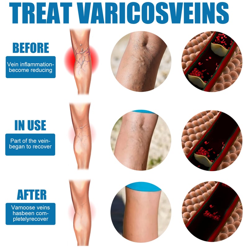 Varicose Veins Spray✨Professional Spray To Restore Healthy Legs!