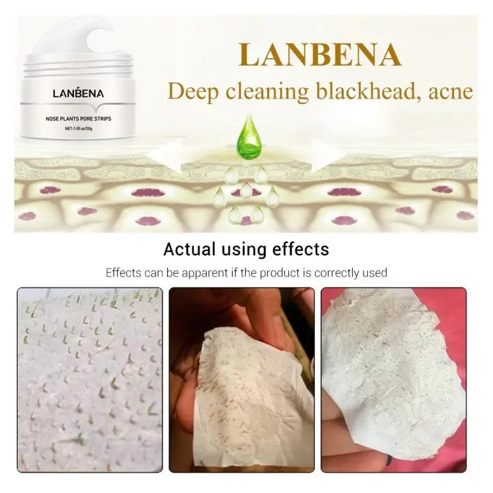 LANBENA Blackhead Remover