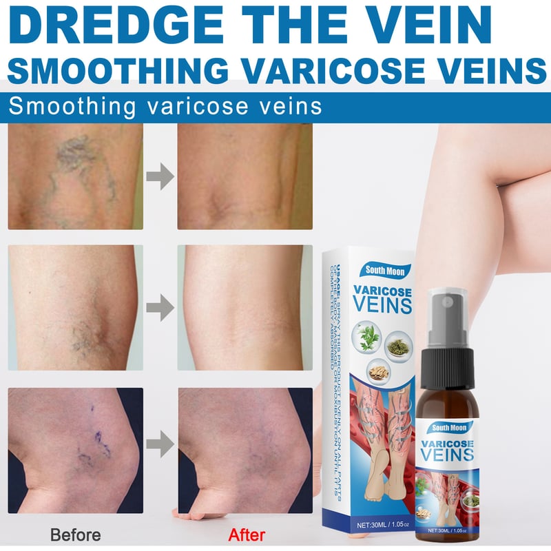 Varicose Veins Spray✨Professional Spray To Restore Healthy Legs! YT