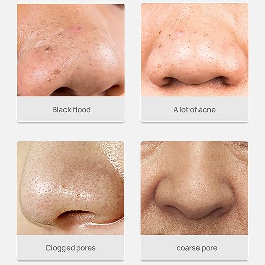 LANBENA Blackhead Remover