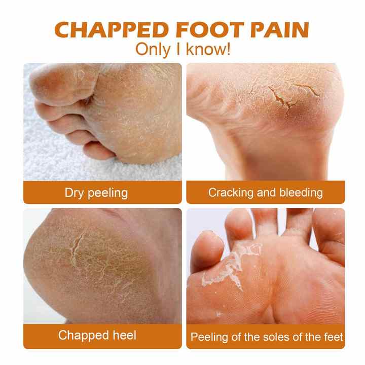 Horse Oil Foot Callus Remedy Balm YT